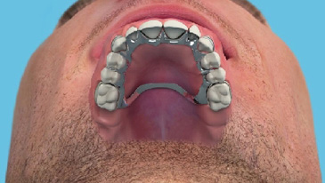 Dentures & Denture Stabilisation