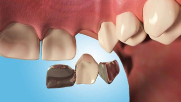 Dental cement for shop bridges