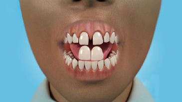 Veneers