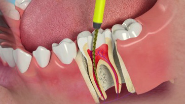 Root Canal Treatment