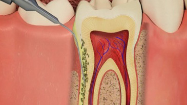 Root Canal Treatment