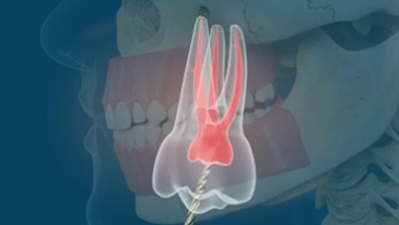 Root Canal Treatment