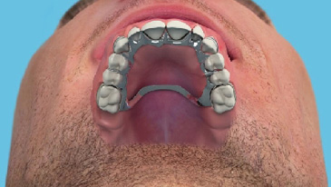 Dentures & Denture Stabilisation